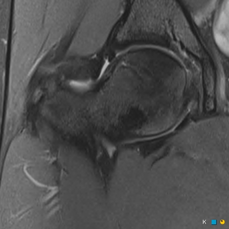 Figure 4 for case reverse slipped upper femoral epiphysis
